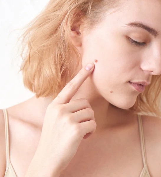 Top Mole, Wart, & Skin Tag Removal Treatments in Borivali Top Mole, Wart, & Skin Tag Removal Treatments in Borivali