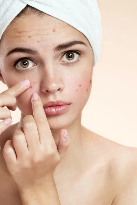 Professional Wart Removal Treatment in Thane, Mumbai Professional Wart Removal Treatment in Thane, Mumbai