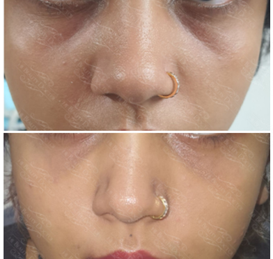 Best Beauty Clinics For Botox Treatment in Thane India Visual comparison of nose surgery results, highlighting improved facial features and rejuvenation.
