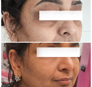 Best Anti Aging Treatment Specialists in Mumbai India Before and after treatment of a woman's nose lift, showing enhanced facial features and youthfulness