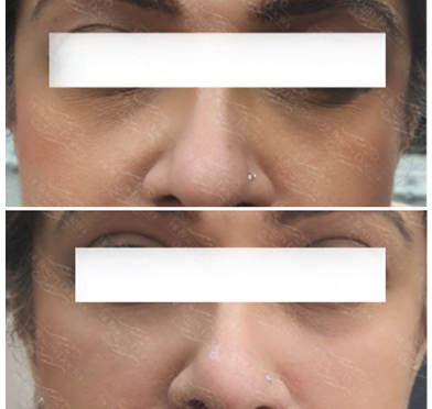 Top Botox Injection Treatments With Best Price in Mumbai  A woman's face clearly shows the transformation from a nose lift, emphasizing youthful appearance