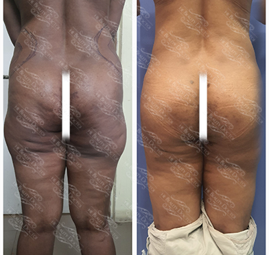 Best Female Thigh Lift Reduction Surgery in Thane, Mumbai Best Female Thigh Lift Reduction Surgery in Thane, Mumbai